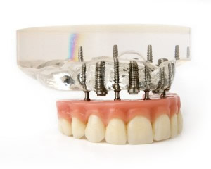 dental-prosthesis-300x240